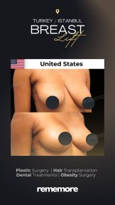 before-after photo mammoplasty