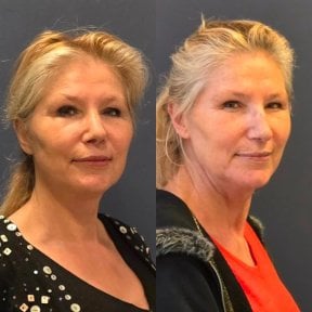 before-after photo lipofilling