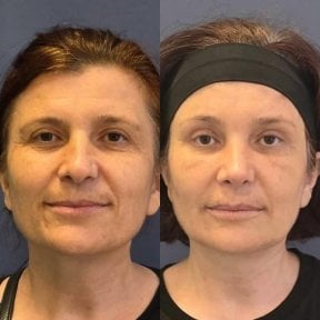 before-after photo lipofilling