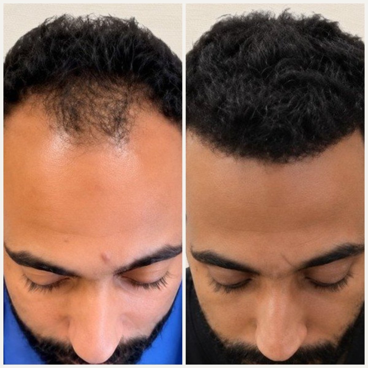 Antes y después de trasplante capilar en HairX Clinics – línea capilar restaurada y mayor densidad