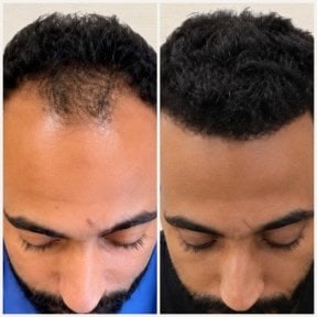 before-after photo hair-transplant