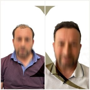 before-after photo hair-transplant