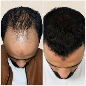 before-after photo hair-transplant