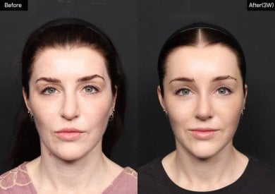 Before and after rhinoplasty results at VG Plastic Surgery, improved nose shape and symmetry