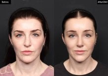 Before and after rhinoplasty results at VG Plastic Surgery, improved nose shape and symmetry