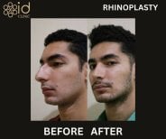 Résultats avant et après rhinoplastie à ID Clinic Bangkok, remodelage du nez naturel