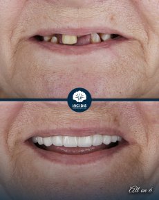 Before and after All-on-6 dental implants result at Inci Dis International Dental Clinic