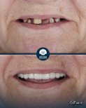 Before and after All-on-6 dental implants result at Inci Dis International Dental Clinic