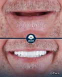 Before and after All-on-6 dental implants result at Inci Dis International Dental Clinic