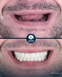 Before and after All-on-6 dental implants result at Inci Dis International Dental Clinic