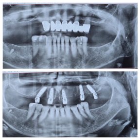Before and after All-on-4 dental implants result at Ader Dent Oral and Dental Health Polyclinic