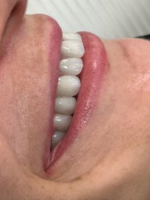 All-on-4 dental implants result at Ader Dent Oral and Dental Health Polyclinic, improved smile