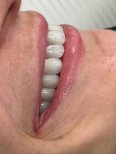 All-on-4 dental implants result at Ader Dent Oral and Dental Health Polyclinic, improved smile
