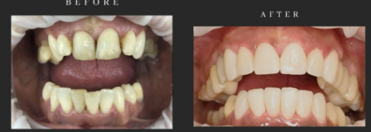Resultado antes y después de implantes dentales All-on-6 en Dental Club Karadzhovi, sonrisa restaurada