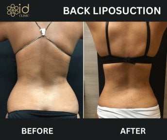 Résultats avant/après liposuccion Vaser du dos à ID Clinic Bangkok, silhouette affinée