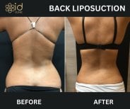 Résultats avant/après liposuccion Vaser du dos à ID Clinic Bangkok, silhouette affinée