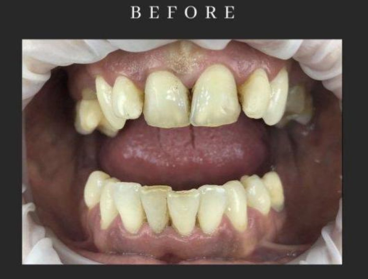 before-after photo