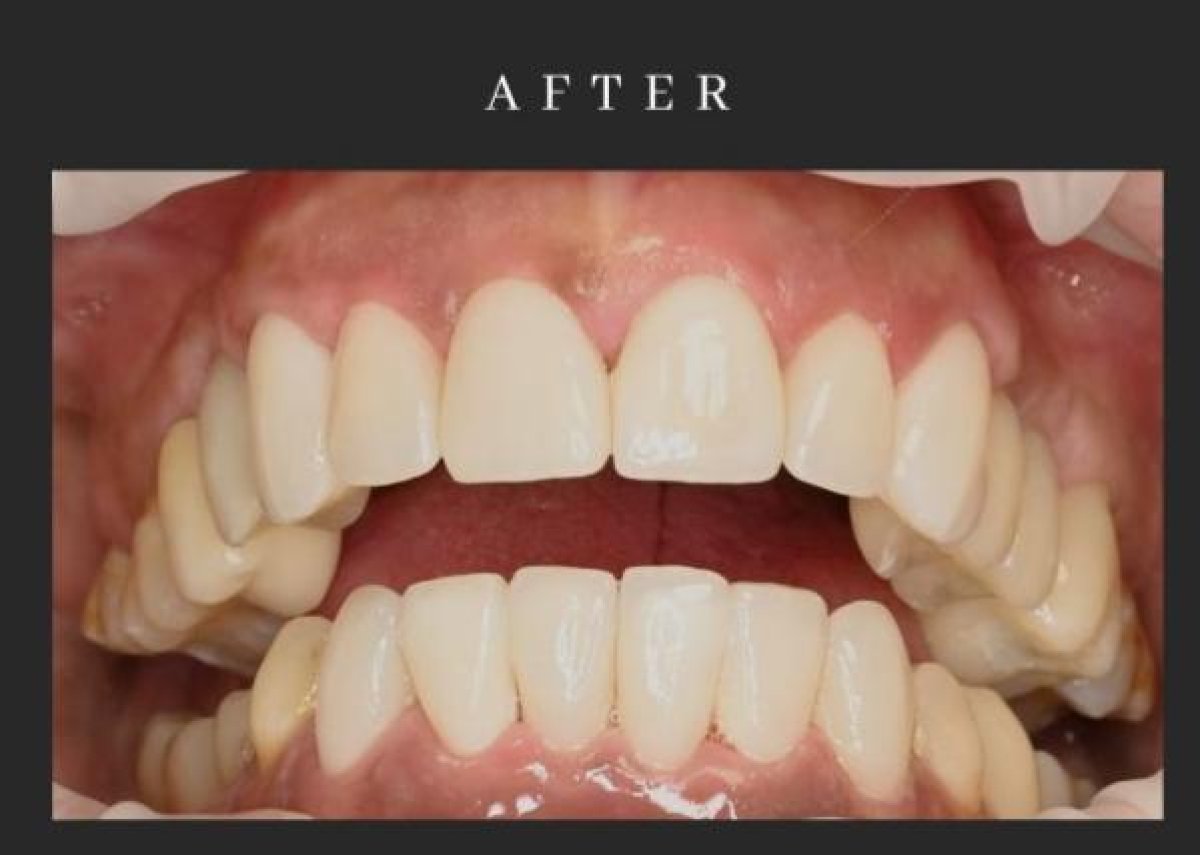 before-after photo