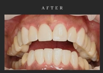before-after photo all-on-6-dental-implants