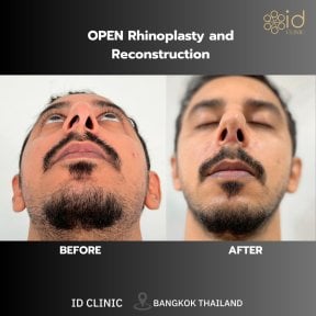 before-after photo rhinoplasty-nose-job