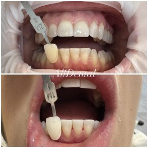 before-after photo otbelivanie-zubov