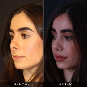 Before and after revision rhinoplasty results at Dr. Hasan Duygulu - Face Aesthetics Clinic Turkey