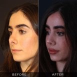 Before and after revision rhinoplasty results at Dr. Hasan Duygulu - Face Aesthetics Clinic Turkey