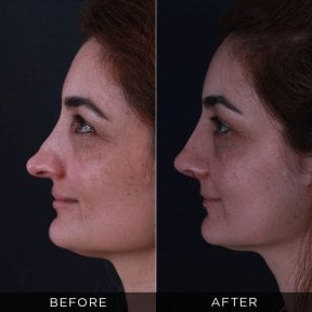 Resultados antes y después de rinoplastia secundaria en Dr. Hasan Duygulu - Face Aesthetics Clinic Turkey