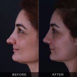 Resultados antes y después de rinoplastia secundaria en Dr. Hasan Duygulu - Face Aesthetics Clinic Turkey