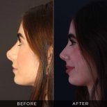 Resultados antes y después de rinoplastia secundaria en Dr. Hasan Duygulu - Face Aesthetics Clinic Turkey