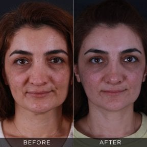 Resultados de rinoplastia de revisión antes y después en Dr. Hasan Duygulu - Face Aesthetics Clinic Turkey