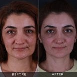 Resultados de rinoplastia de revisión antes y después en Dr. Hasan Duygulu - Face Aesthetics Clinic Turkey