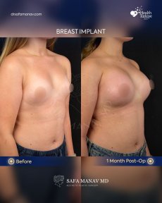 before-after photo uvelicenie-grudi