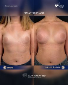 before-after photo uvelicenie-grudi