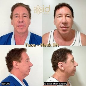 before-after photo tightening-of-facial-skin-facelift