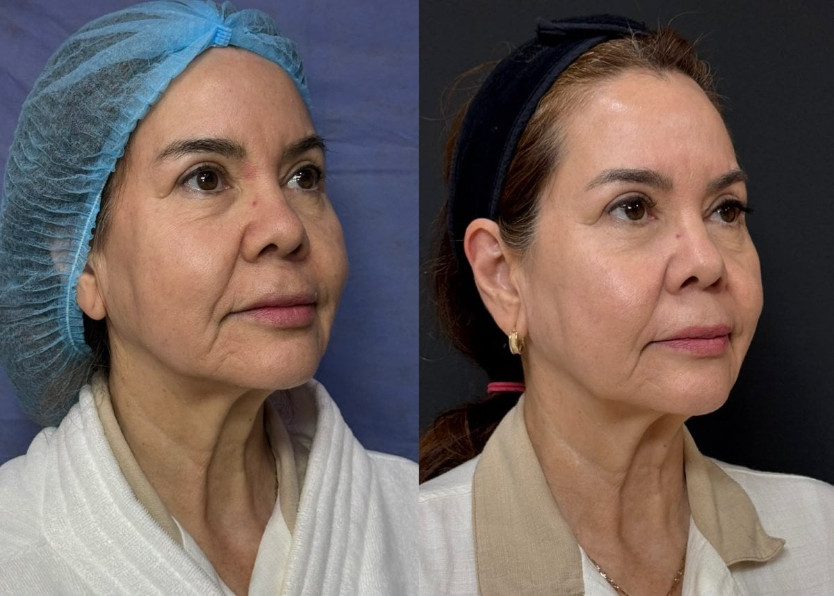 Resultados de minilifting facial antes y después, rejuvenecimiento y mandíbula más lisa