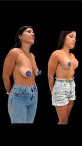 before-after photo breast-augmentation