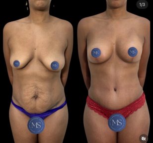 before-after photo breast-augmentation