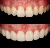 Before and after no prep veneers results at Blanche clinic – brighter, even smile transformation