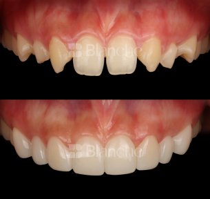 Before and after no prep veneers result at Blanche clinic – smile transformation