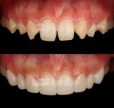 Before and after no prep veneers result at Blanche clinic – smile transformation