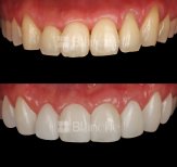 Before and after no prep veneers results at Blanche clinic – smile transformation