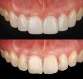 Before and after no prep veneers results at Blanche clinic – improved smile aesthetics