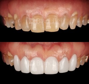 Before and after no prep veneers results at Blanche clinic – smile transformation
