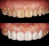 Before and after no prep veneers results at Blanche clinic – smile transformation