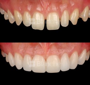 Before and after no prep veneers results at Blanche clinic – smile makeover with natural look