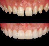 Before and after no prep veneers results at Blanche clinic – smile makeover with natural look