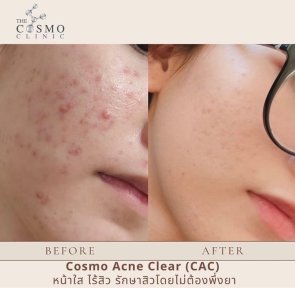 Результаты до и после лечения рубцов от акне в The Cosmo Clinic, более гладкая кожа