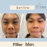 Résultats avant-après des fillers sous les yeux à The Cosmo Clinic, cernes réduites