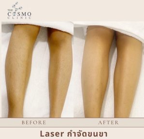 Результаты до и после лазерной эпиляции ног в The Cosmo Clinic, гладкая кожа